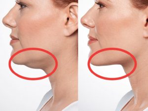 لاغری غبغب بدون جراحی
