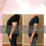 لاغری بدون جراحی با دکتر اسمعیلی