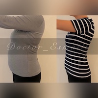 لاغری موضعی