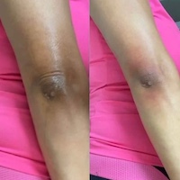 درمان تیرگی و لک