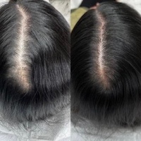 درمان ریزش مو