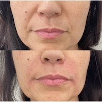 فیلر خط لبخند